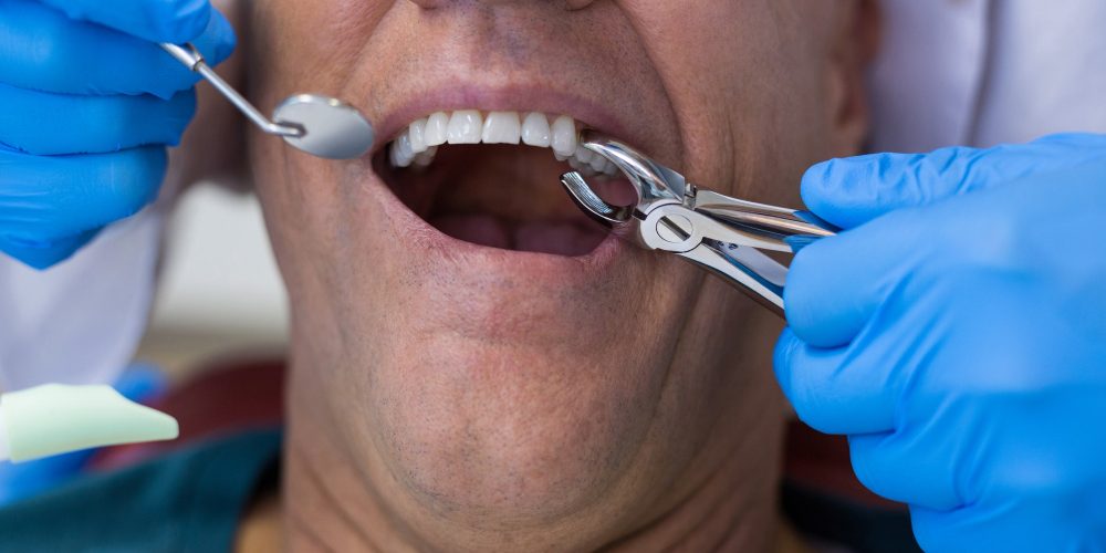 Dentist using surgical pliers to remove a decaying tooth